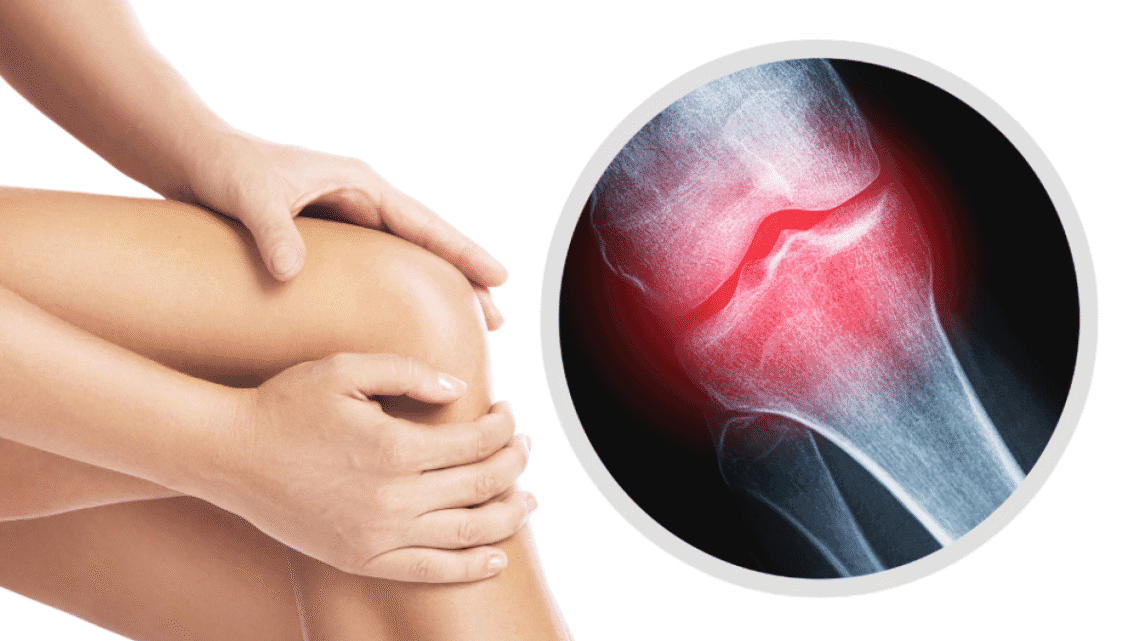 Fracture osseuse : quel complément alimentaire peut vraiment aider ?